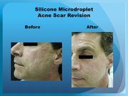 Silicone Microdroplet Acne Scar Revision