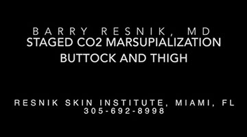  Staged CO2 Marsupialization Buttock and Thigh 