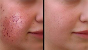 CROSS Technique (Chemical Reconstruction of Skin Scars)