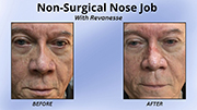 Non-surgical nose job with revanesse and microdroplet silicone for acne scars