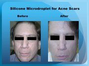 Silicone Microdroplet for Acne Scars