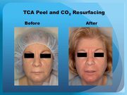 TCA Peel and CO2 Resurfacing