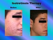 Isotretinoin Therapy