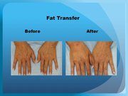 Fat Transfer