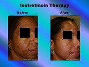 Isotretinoin Therapy