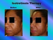 Isotretinoin Therapy