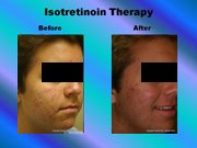 Isotretinoin Therapy