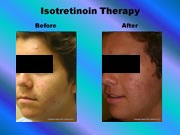 Isotretinoin Therapy