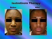 Isotretinoin Therapy