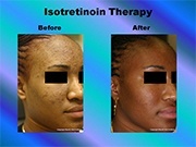 Isotretinoin Therapy