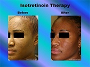 Isotretinoin Therapy