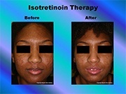 Isotretinoin Therapy