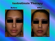 Isotretinoin Therapy