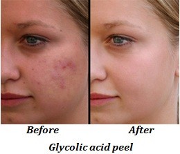 Glycolic acid peel (before and after)