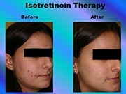 Isotretinoin Therapy