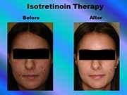 Isotretinoin Therapy