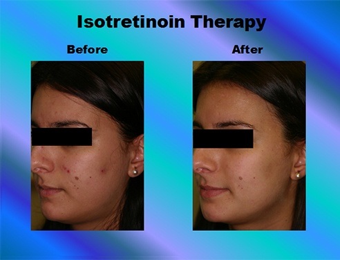 Resnik Skin Institute, Aventura Florida - Barry I. Resnik MD - Treatment  with Isotretinoin for Severe or Unresponsive Acne
