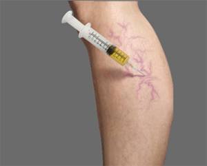 Injection Sclerotherapy for Leg Vessels
