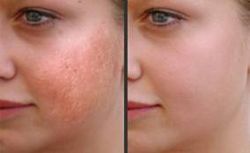 Laser Skin Resurfacing Aventura Fl Skin Rejuvenation Treatment Aventura Fl