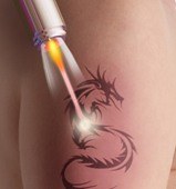 Laser tattoo removal, Aventura