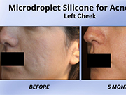 Non-surgical nose job with revanesse and microdroplet silicone for acne scars