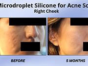 Non-surgical nose job with revanesse and microdroplet silicone for acne scars