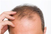 Léčba alopecie kyselinou skvarinovou