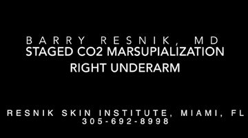 Staged CO2 Marsupialization Right Underarm