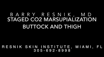 Staged CO2 Marsupialization Buttock and Thigh