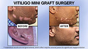 Vitiligo Mini Graft Surgery