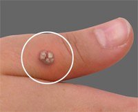 Warts - Kissed any Frogs Today?